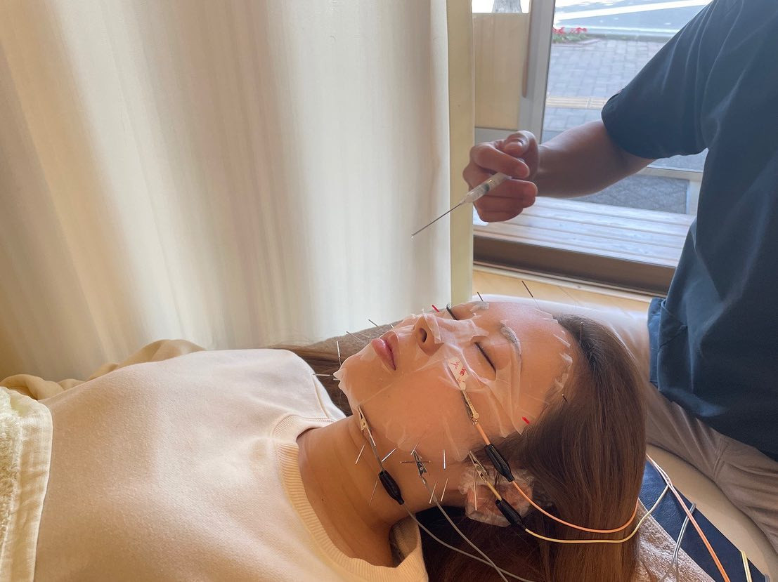 この間、こば鍼灸整骨さん（@kobari_sapporo）へ
行ってきたのでレポートを書きます📑✏️

・

ヒト臍帯血幹細胞フェイスシートをしたまま
顔全体に電気美容鍼を刺す、施術をしてきました🪡💆🏼‍♀️⚡️

ヒト臍帯血幹細胞フェイスシートだから
肌の再生効果もあるらしい🦠🧬♻️

・

初めて美容鍼に行ったので
痛いのかな？とか思い
緊張したけど、ほぼ痛くなかった🧏🏼‍♀️✨

施術後の効果は
目が開いたのと肌が白くなった🤍🫧🪄
（ノーマルカメラで撮った
　ビフォーアフターの写真を載せたいですが
