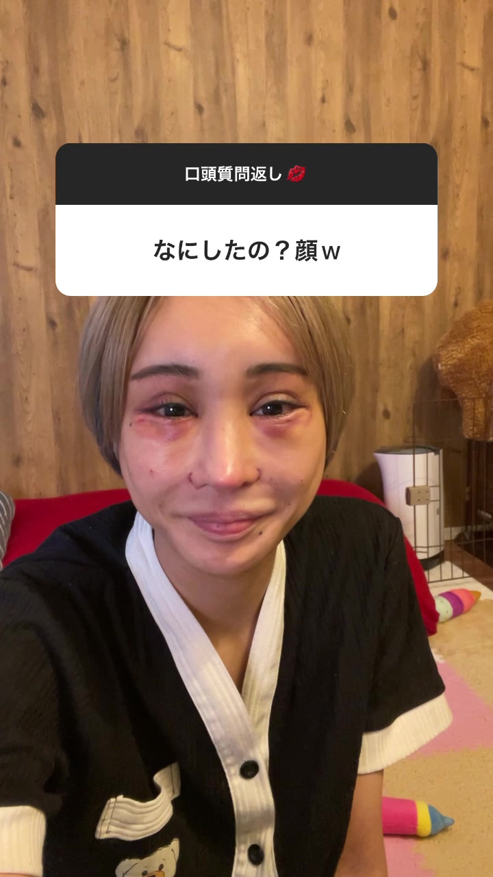 目が覚めたらこうなってただけの話よ。#インスタグラム#ストーリーズ#切り抜き#整形#ダウンタイム#クマ取り#涙袋形成