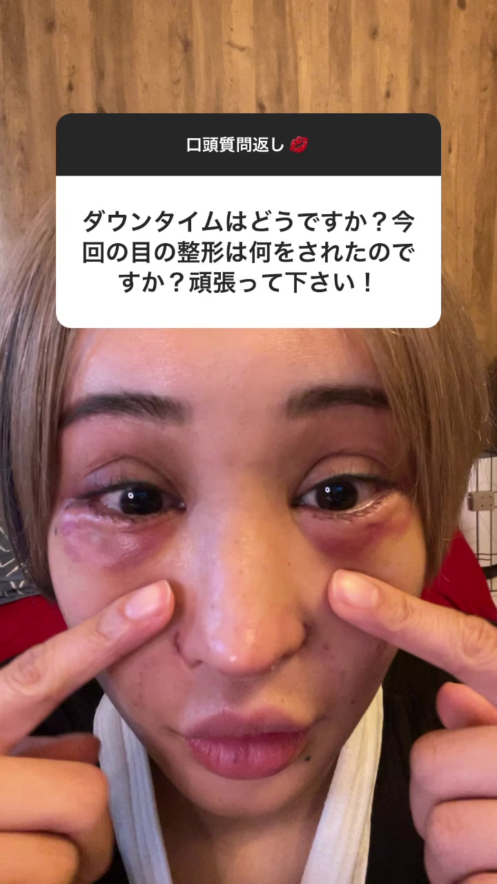 これ、かなり童顔になったので、童顔になりたい人はお勧めよ❤️#美容整形#整形#クマ取り#涙袋形成#ダウンタイム