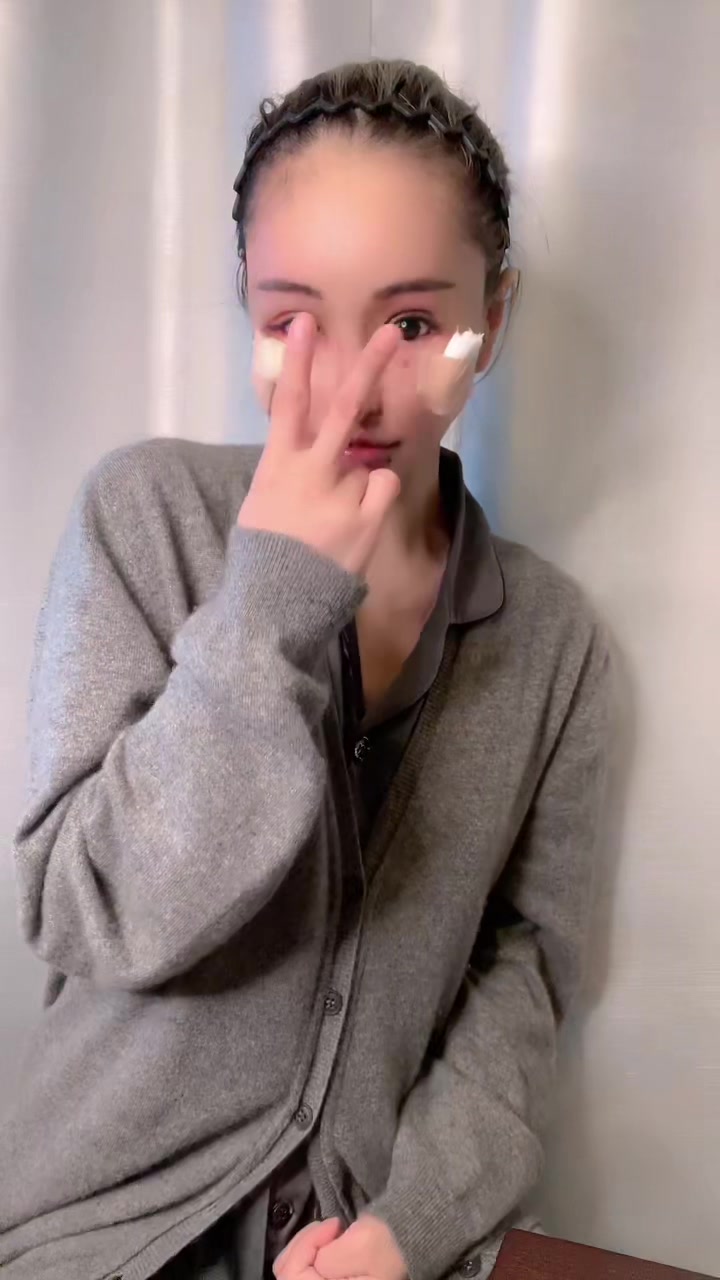 ダウンタイム中〜🎶 TikTokのエフェクトが最強過ぎてダウンタイム中に見えない🤣💕 #美容整形#整形#眼窩縁#骨削り#逆さまつ毛修正#涙袋形成#目頭修正#鼻先修正