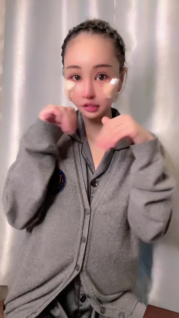 ダウンタイム中〜🎶 TikTokのエフェクトが最強過ぎて術後２日目のダウンタイム中に見えない🤣💕 #美容整形#整形#眼窩縁#骨削り#逆さまつ毛修正#涙袋形成#目頭修正#鼻先修正#invitation