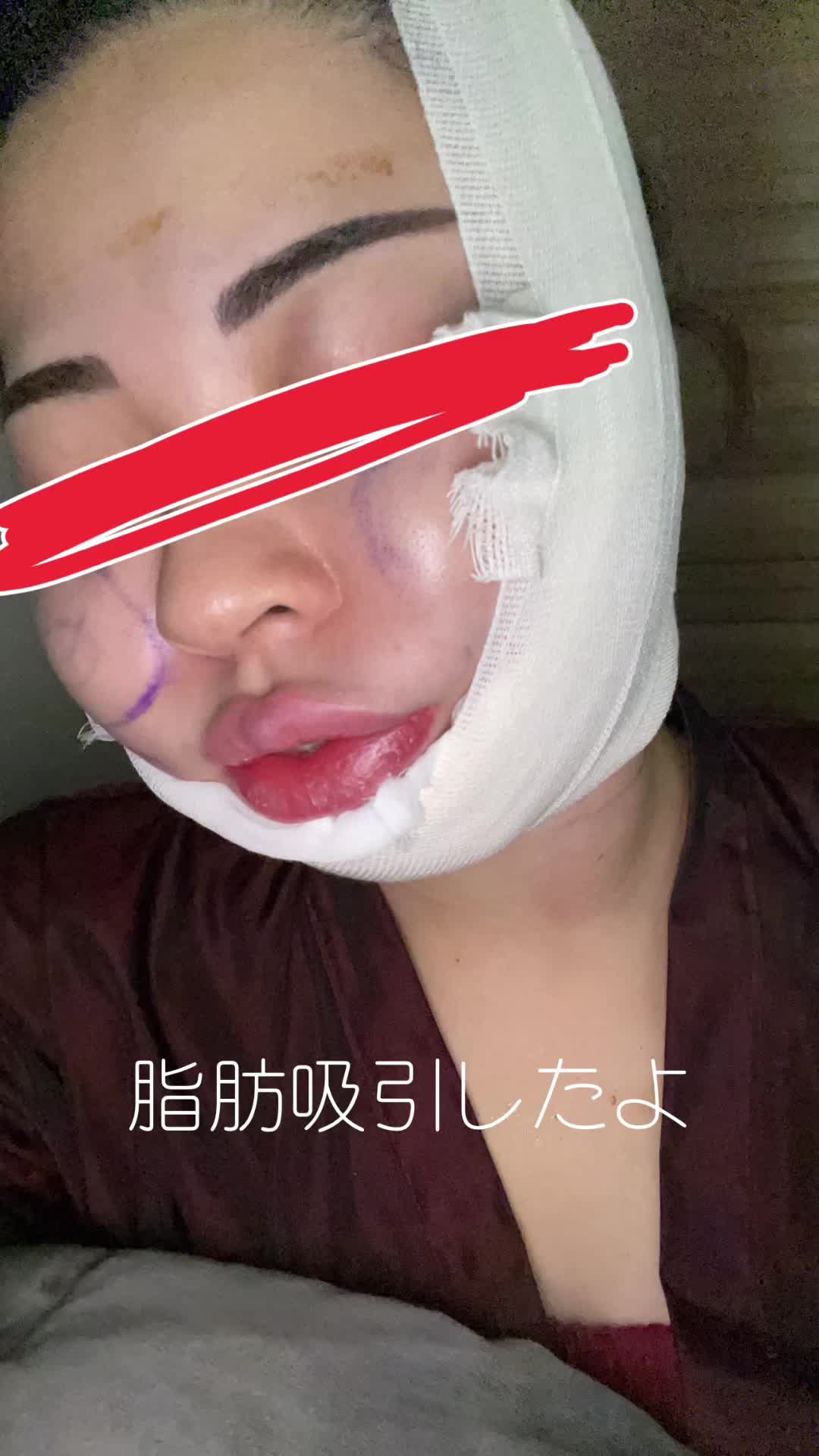 脂肪吸引は術後が痛い🥹🥹🥹#ヒカキンボイス #韓国整形 #韓国