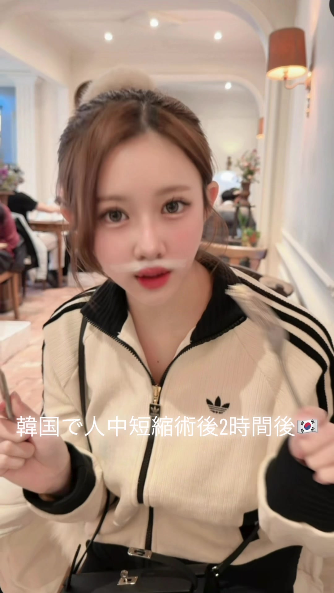 年内最後の整形はずっーーと したかった人中短縮！一年以上カウンセリング回ってやっとの思いでオペ😭😭✨また詳しく載せます良いお年を🕊️ #キャバ嬢 #整形 #韓国整形 #人中短縮
