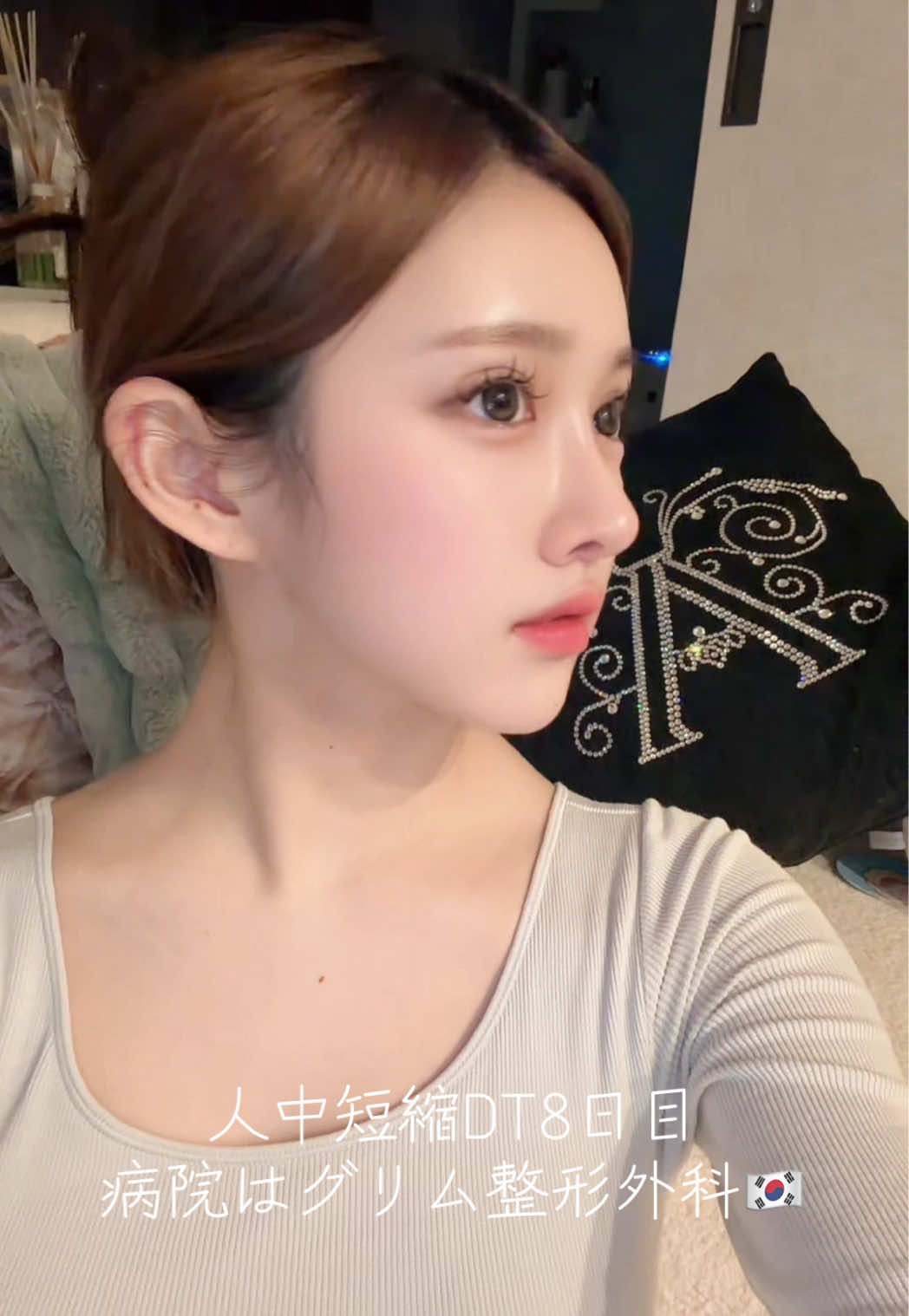 人中短縮＋cカール＋溝形成から8日経ちました🕊️ 抜糸は6日目にしたよ！ そもそもあざなし腫れも酷くなくて もう傷跡も綺麗で後は腫れ引くのみ！術後の自分のケアが大事！ 完成が楽しみ🥹🥹✨ #キャバ嬢 #整形 #人中短縮